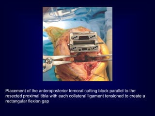 Placement of the anteroposterior femoral cutting block parallel to the
resected proximal tibia with each collateral ligament tensioned to create a
rectangular flexion gap.
 