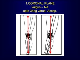 1.CORONAL PLANE
valgus – NA
upto 3deg varus- Accep.
 