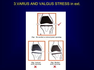 3.VARUS AND VALGUS STRESS in ext.
 