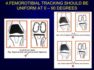 4.FEMOROTIBIAL TRACKING SHOULD BE
UNIFORM AT 0 – 90 DEGREES
 