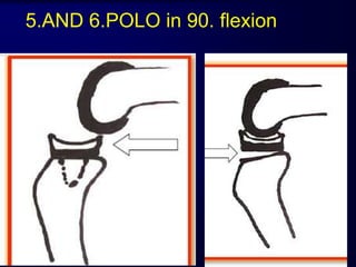 5.AND 6.POLO in 90. flexion
 