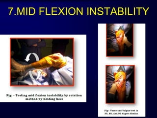 7.MID FLEXION INSTABILITY
 