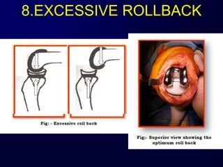8.EXCESSIVE ROLLBACK
 