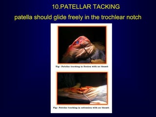 10.PATELLAR TACKING
patella should glide freely in the trochlear notch
 