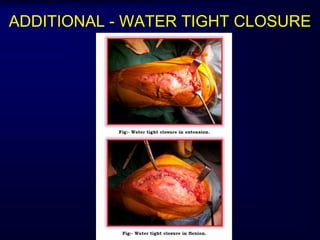 ADDITIONAL - WATER TIGHT CLOSURE
 