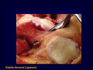 Patello-femoral Ligament
 