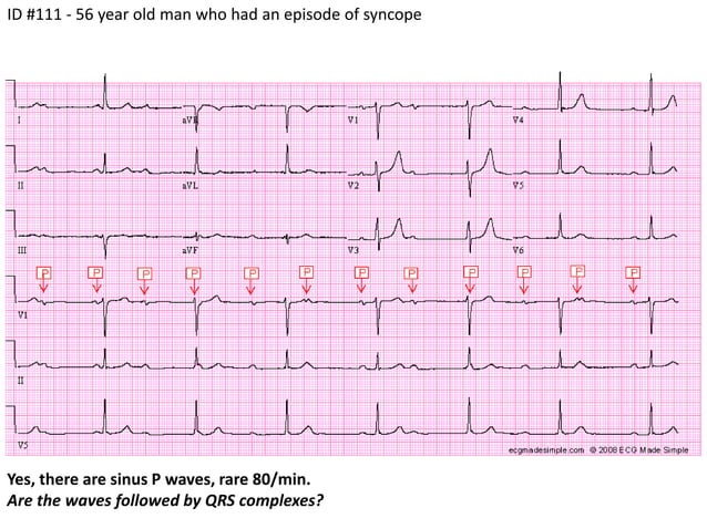 Stepwise Interpretation Ecg 12 Ppt