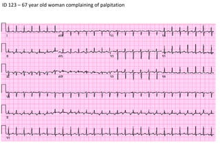 ID 123 – 67 year old woman complaining of palpitation 