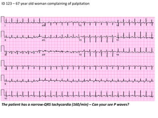 ID 123 – 67 year old woman complaining of palpitation The patient has a narrow-QRS tachycardia (160/min) – Can your see P waves? 