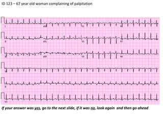 ID 123 – 67 year old woman complaining of palpitation If your answer was  yes , go to the next slide, if it was  no , look again  and then go ahead 