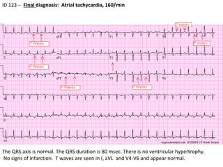 ID 123 –  Final  diagnosis:  Atrial tachycardia, 160/min The QRS axis is normal. The QRS duration is 80 msec. There is no ventricular hypertrophy. No signs of infarction.  T waves are seen in I, aVL  and V4-V6 and appear normal. 