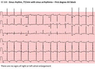 ID 168 -  Sinus rhythm, 77/min with sinus arrhythmia – First degree AV block  There are no signs of right or left atrial enlargement 