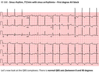 ID 168 -  Sinus rhythm, 77/min with sinus arrhythmia – First degree AV block  Let’s now look at the QRS complexes: There is  normal QRS axis (between 0 and 90 degrees 