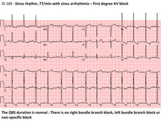 The QRS duration is normal : There is no right bundle branch block, left bundle branch block or non‐specific block  ID 168 -  Sinus rhythm, 77/min with sinus arrhythmia – First degree AV block  