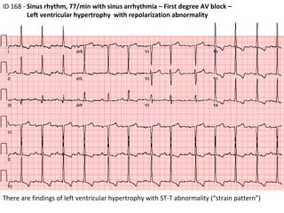 ID 168 -  Sinus rhythm, 77/min with sinus arrhythmia – First degree AV block – Left ventricular hypertrophy  with repolarization abnormality  There are findings of left ventricular hypertrophy with ST-T abnormality (“strain pattern”) 
