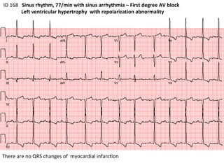 ID 168  Sinus rhythm, 77/min with sinus arrhythmia – First degree AV block Left ventricular hypertrophy  with repolarization abnormality  There are no QRS changes of  myocardial infarction 