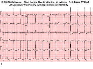 ID 168  Final diagnosis  -  Sinus rhythm, 77/min with sinus arrhythmia – First degree AV block Left ventricular hypertrophy  with repolarization abnormality  T 
