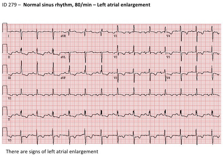 Stepwise Interpretation Of ECG ID279