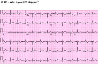 ID 419 – What is your ECG diagnosis? 
