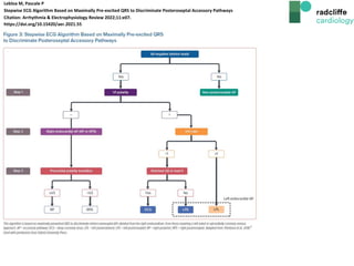 Lebloa M, Pascale P
Stepwise ECG Algorithm Based on Maximally Pre-excited QRS to Discriminate Posteroseptal Accessory Pathways
Citation: Arrhythmia & Electrophysiology Review 2022;11:e07.
https://doi.org/10.15420/aer.2021.55
 