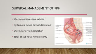 SURGICAL MANAGEMENT OF PPH
• Uterine compression sutures
• Systematic pelvic devascularization
• Uterine artery embolization
• Total or sub-total hysterectomy
 
