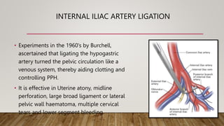 INTERNAL ILIAC ARTERY LIGATION
• Experiments in the 1960’s by Burchell,
ascertained that ligating the hypogastric
artery turned the pelvic circulation like a
venous system, thereby aiding clotting and
controlling PPH.
• It is effective in Uterine atony, midline
perforation, large broad ligament or lateral
pelvic wall haematoma, multiple cervical
tears and lower segment bleeding.
 
