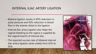 INTERNAL ILIAC ARTERY LIGATION
• Bilateral ligation results in 85% reduction in
pulse pressure and 50% reduction in blood
flow in the arteries distal to the ligation.
• Internal iliac artery ligation also helps the
vaginal bleeding as the vagina is supplied by
the vaginal branch of internal iliac.
• The reported success rate of bilateral internal
iliac artery ligation varies widely from 42% to
93%.
 