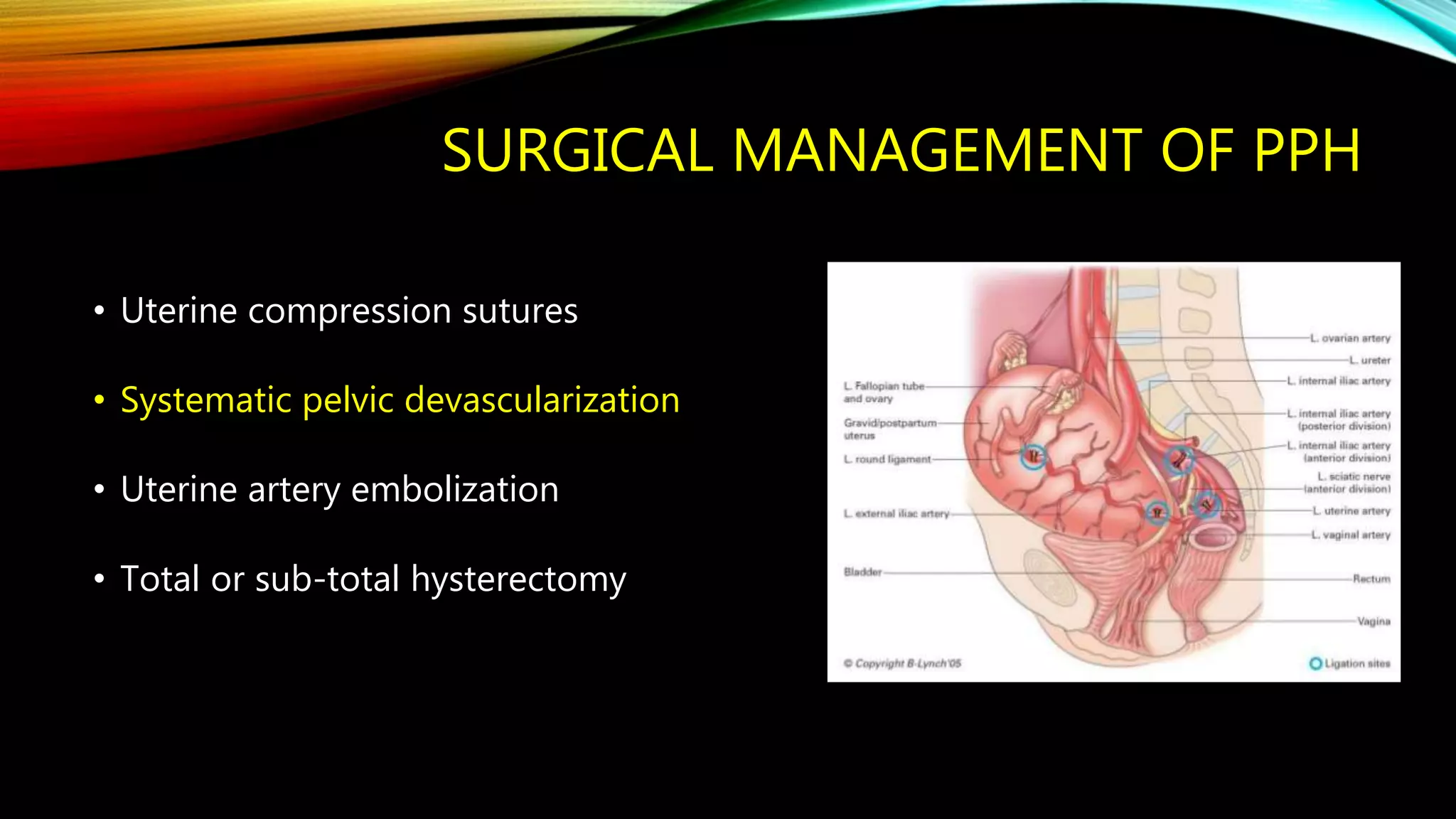 Step wise pelvic devascularisation | PPTX