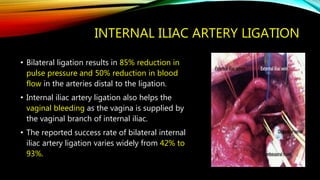 INTERNAL ILIAC ARTERY LIGATION
• Bilateral ligation results in 85% reduction in
pulse pressure and 50% reduction in blood
flow in the arteries distal to the ligation.
• Internal iliac artery ligation also helps the
vaginal bleeding as the vagina is supplied by
the vaginal branch of internal iliac.
• The reported success rate of bilateral internal
iliac artery ligation varies widely from 42% to
93%.
 