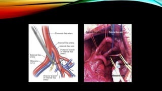 INTERNAL ILIAC ARTERY LIGATION
 
