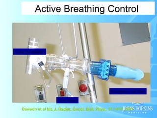 Stereotactic Body Radiation Therapy | PPT