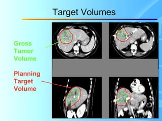 Target Volume Radiotherapy Stereotactic Body Radiation Therapy | PPT