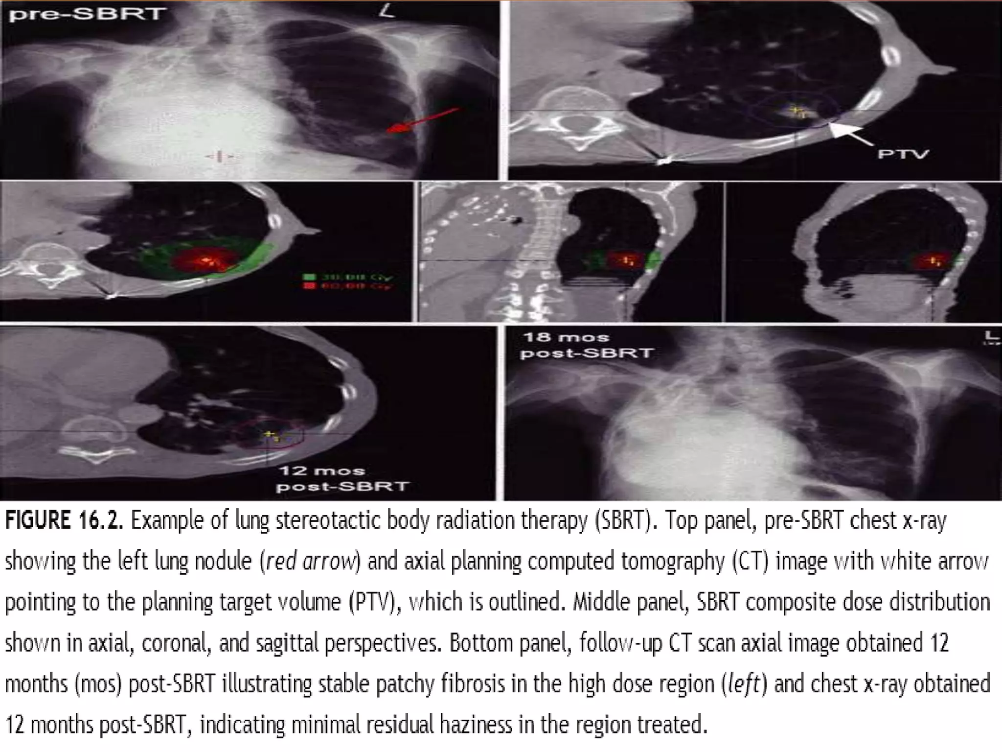 Stereotactic body radiation therapy