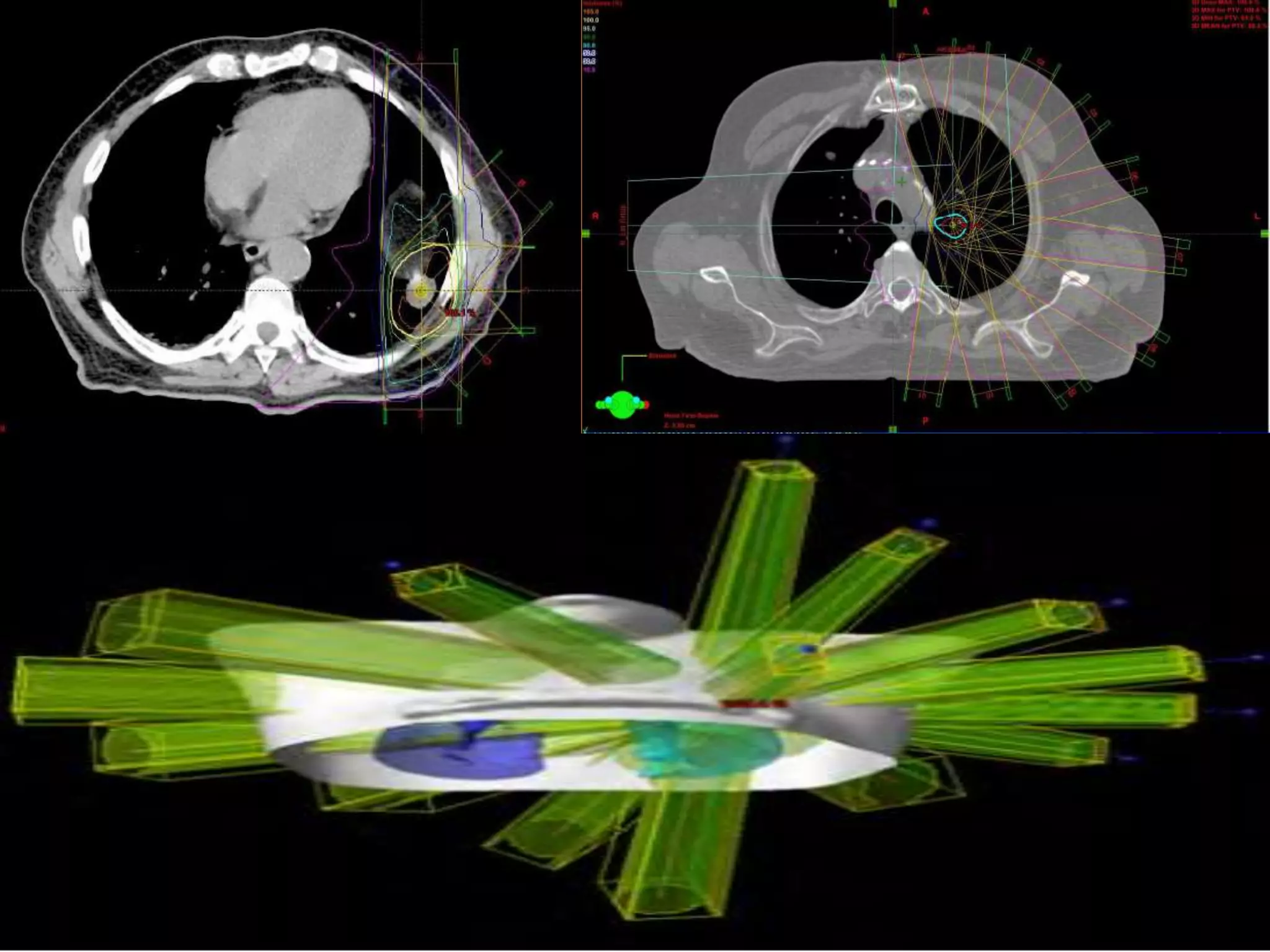 Stereotactic body radiation therapy