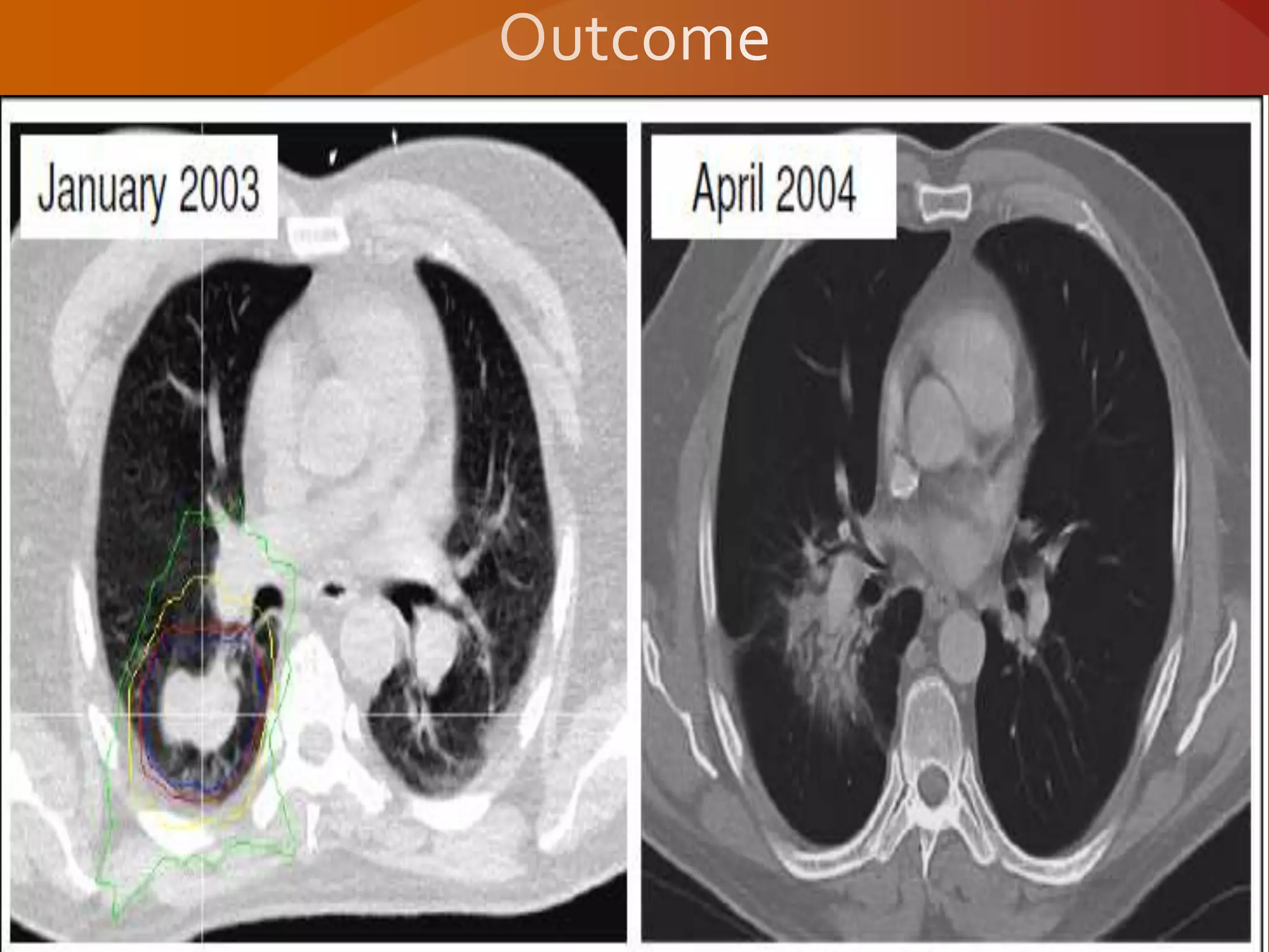 Stereotactic body radiation therapy