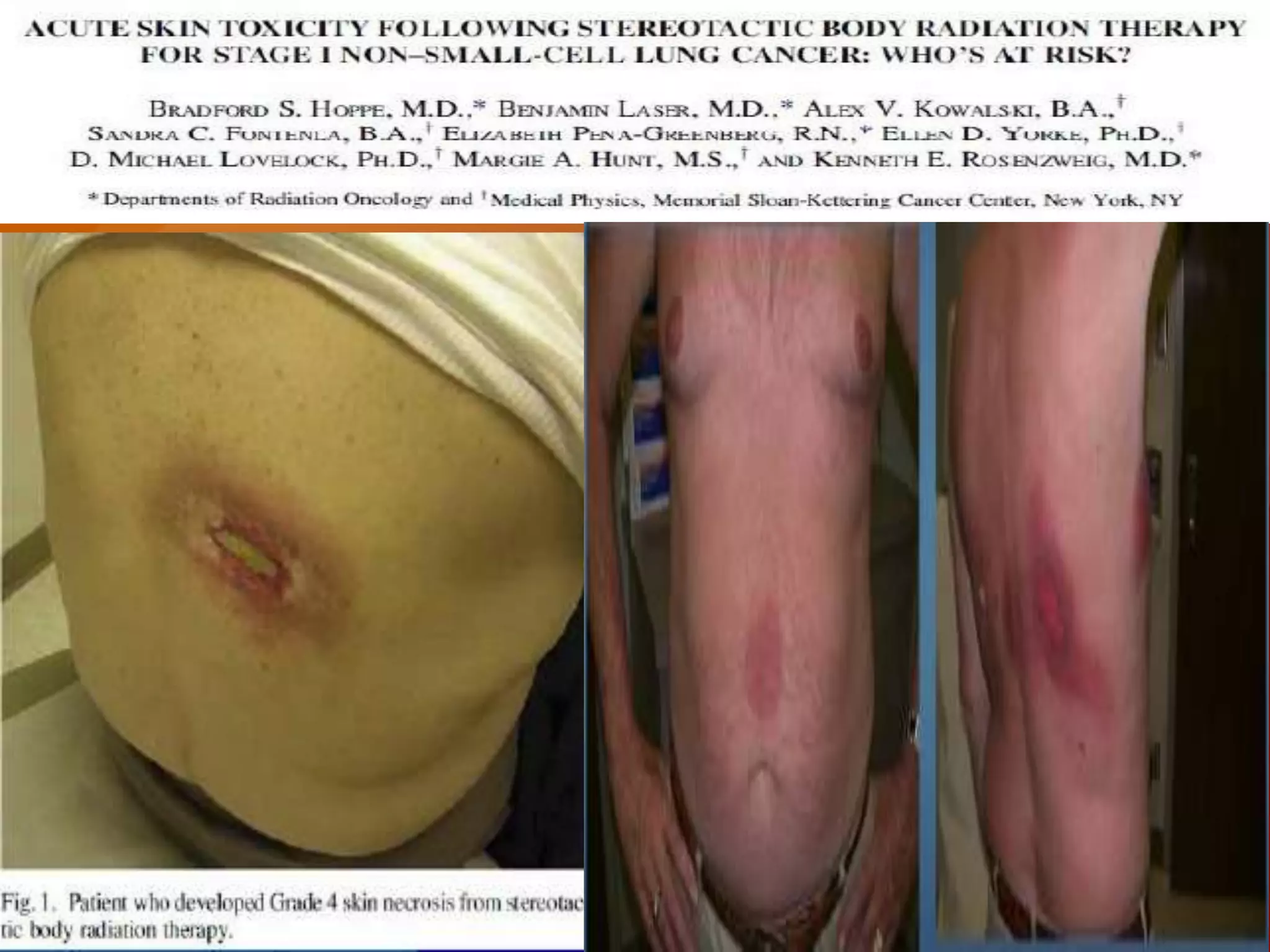 Stereotactic body radiation therapy