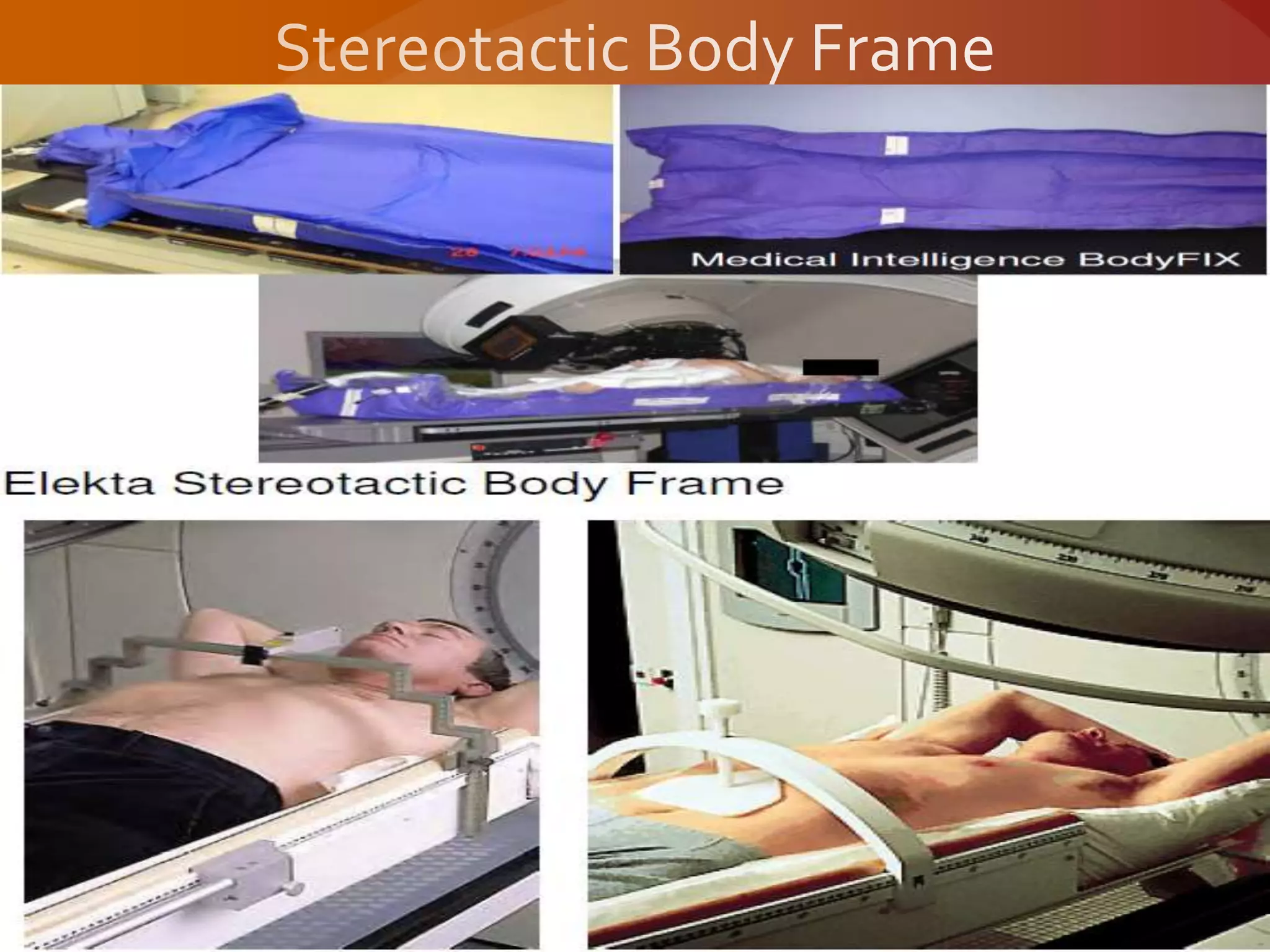 Stereotactic body radiation therapy