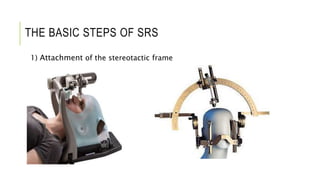ARTERIOVENOUS MALFORMATION RADIOTHERAPY | PPTX