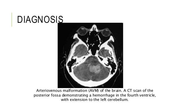arteriovenous malformation radiotherapy