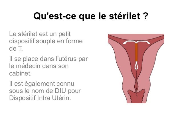 sterilet pour femme