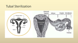 Tubal Sterilization
 