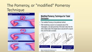 The Pomeroy, or "modified" Pomeroy
Technique
 