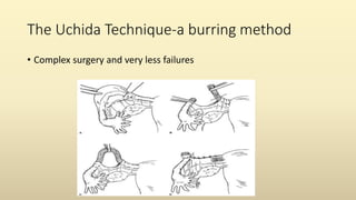 The Uchida Technique-a burring method
• Complex surgery and very less failures
 