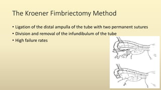 The Kroener Fimbriectomy Method
• Ligation of the distal ampulla of the tube with two permanent sutures
• Division and removal of the infundibulum of the tube
• High failure rates
 
