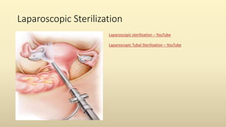 Laparoscopic Sterilization
Laparoscopic sterilization – YouTube
Laparoscopic Tubal Sterilization – YouTube
 