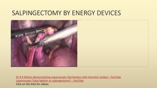 SALPINGECTOMY BY ENERGY DEVICES
Dr R K Mishra demonstrating Laparoscopic Sterilization with Harminic Scalpel – YouTube
Laparoscopic Tubal ligation or salpingectomy? – YouTube
Click on the links for videos
 