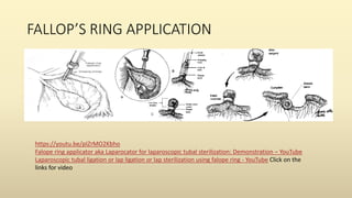 FALLOP’S RING APPLICATION
https://youtu.be/pIZrMO2Kbho
Falope ring applicator aka Laparocator for laparoscopic tubal sterilization: Demonstration – YouTube
Laparoscopic tubal ligation or lap ligation or lap sterilization using falope ring - YouTube Click on the
links for video
 