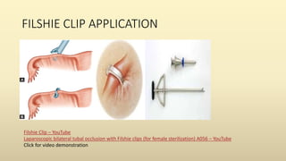 FILSHIE CLIP APPLICATION
Filshie Clip – YouTube
Laparoscopic bilateral tubal occlusion with Filshie clips (for female sterilization) A056 – YouTube
Click for video demonstration
 