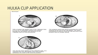 HULKA CLIP APPLICATION
 