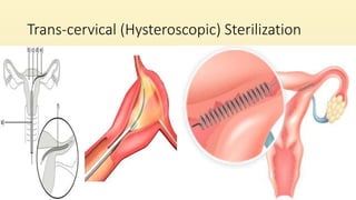 Trans-cervical (Hysteroscopic) Sterilization
 